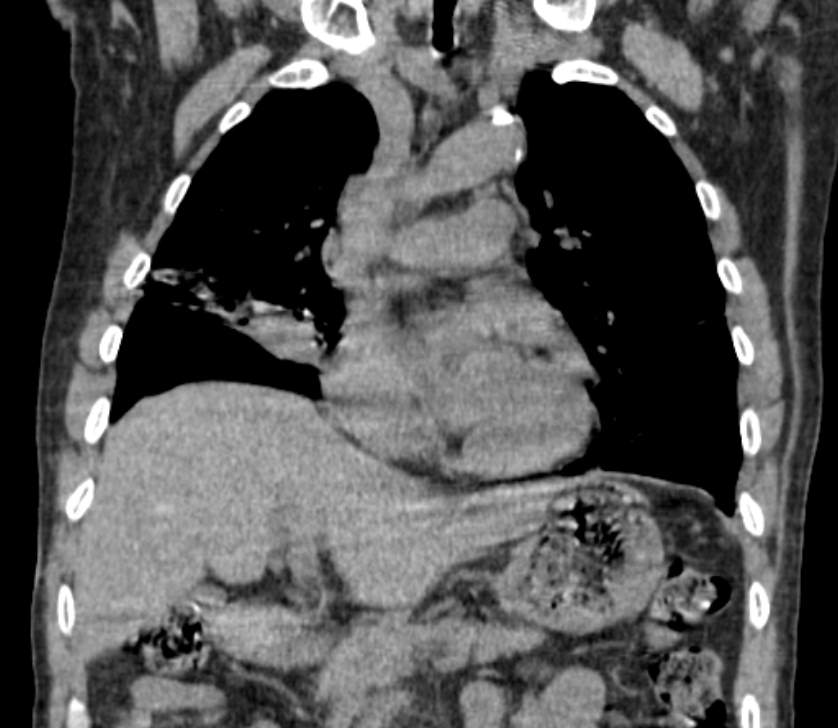 Airway foreign body in adult (Radiopaedia 85907-101779 Coronal liver window 111).jpg