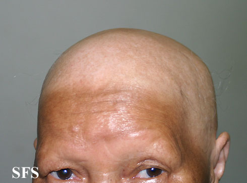 Alopecia Areata (Dermatology Atlas 26).jpg
