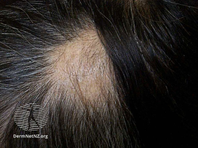 File:Alopecia areata (DermNet NZ hair-nails-sweat-alopecia1).jpg
