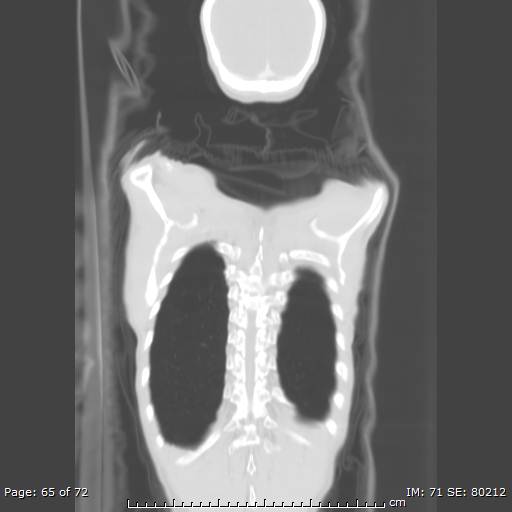 Alpha-1-antitrypsin deficiency (Radiopaedia 50561-55987 Coronal lung window 63).jpg