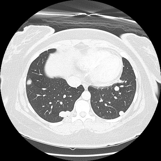 Alveolar soft part sarcoma - right leg (Radiopaedia 59432-67091 Axial lung window 84).jpg