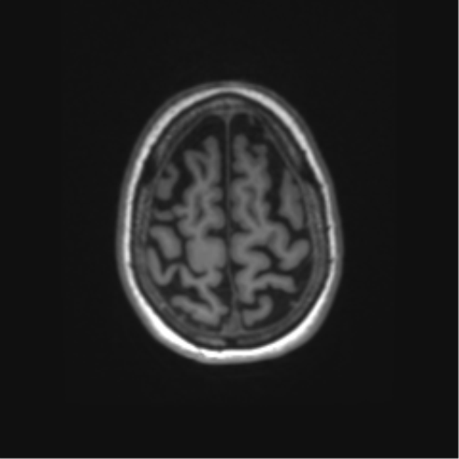 Alzheimer's disease (Radiopaedia 42658-45802 Axial T1 30).png