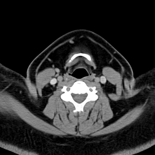 Ameloblastoma (Radiopaedia 38520-40623 Axial non-contrast 46).png