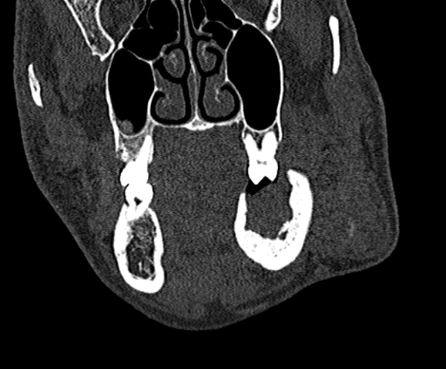 Ameloblastoma (Radiopaedia 51921-57766 Coronal bone window 86).jpg