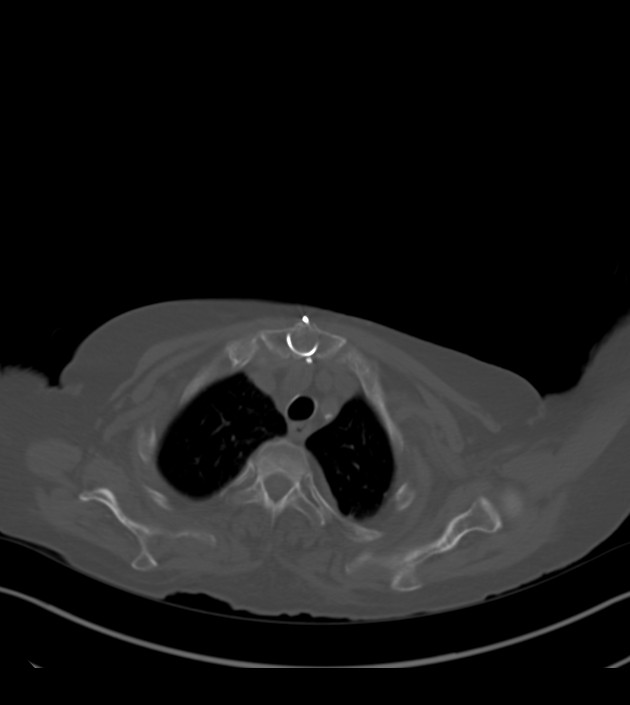 Amiodarone deposition in the liver (Radiopaedia 77587-89780 Axial bone window 14).jpg