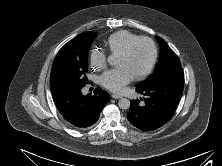 Amiodarone lung (Radiopaedia 62514-70769 Axial non-contrast 50).jpg