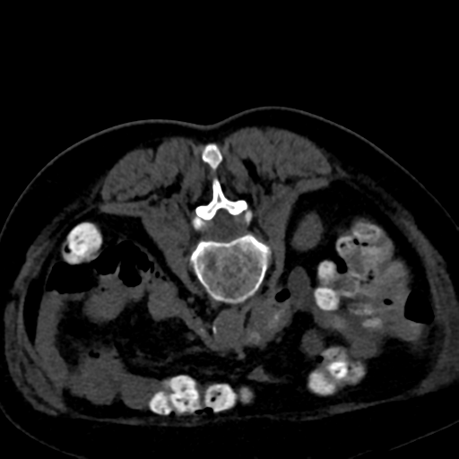Ampullary adenocarcinoma (Radiopaedia 34013-35241 C 58).png