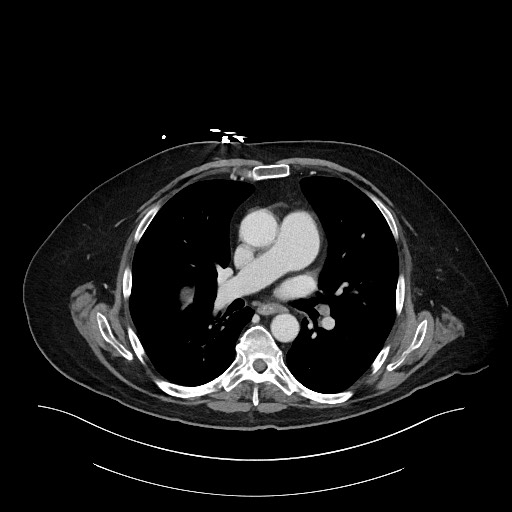 Ampullary adenocarcinoma (Radiopaedia 59373-66734 C 3).jpg
