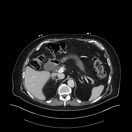 Ampullary adenocarcinoma (Radiopaedia 59373-66734 C 46).jpg