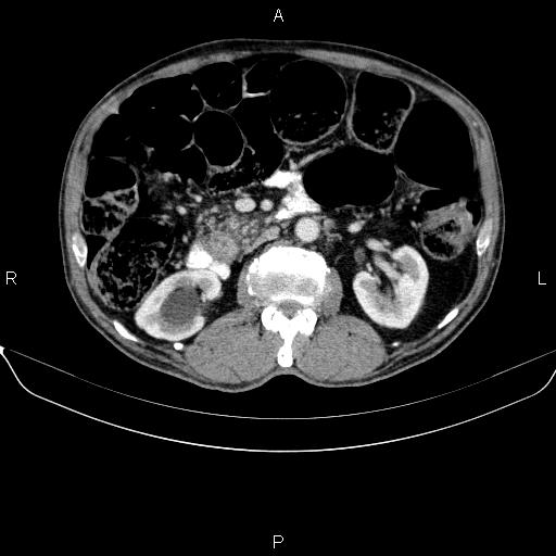 Ampullary adenocarcinoma (Radiopaedia 86093-102032 A 26).jpg