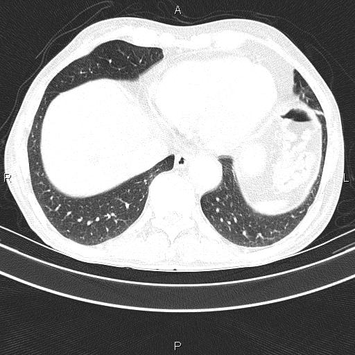Ampullary adenocarcinoma (Radiopaedia 86093-102033 Axial lung window 46).jpg