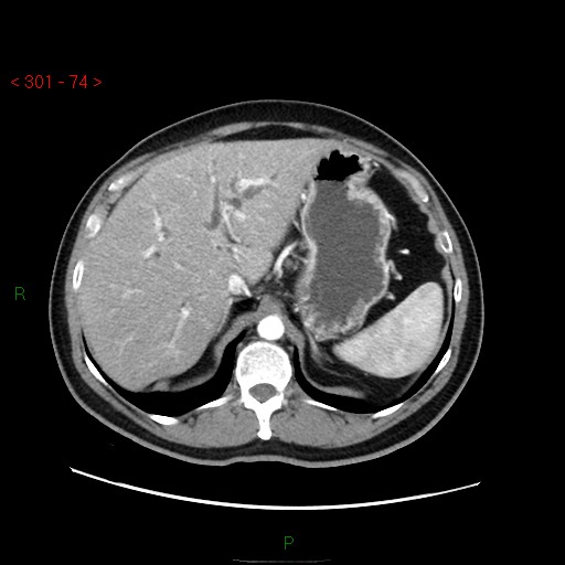 File:Ampullary carcinoma (Radiopaedia 56396-63056 B 20).jpg