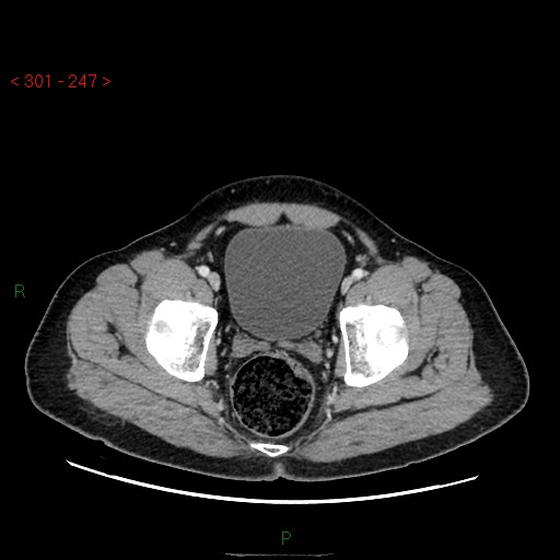 Ampullary carcinoma (Radiopaedia 56396-63056 C 92).jpg