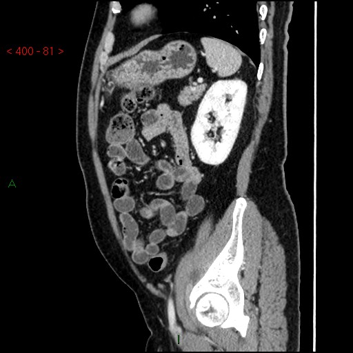 Ampullary carcinoma (Radiopaedia 56396-63056 D 80).jpg