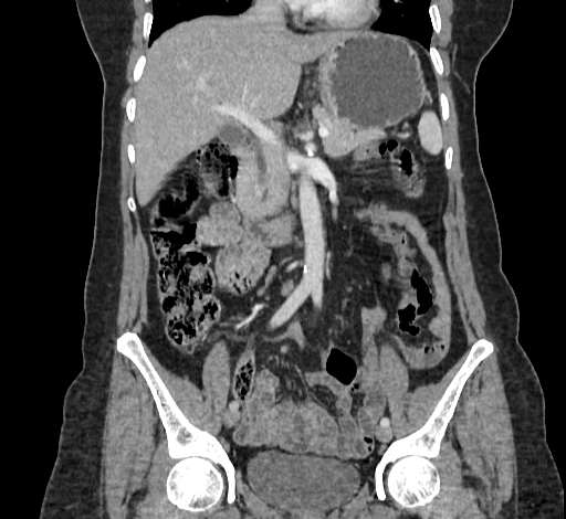 Ampullary tumor (Radiopaedia 60333-67998 B 36).jpg