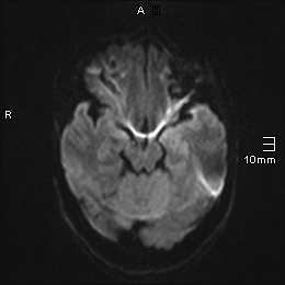 File:Amyotrophic lateral sclerosis (Radiopaedia 70821-81017 Axial DWI 4).jpg