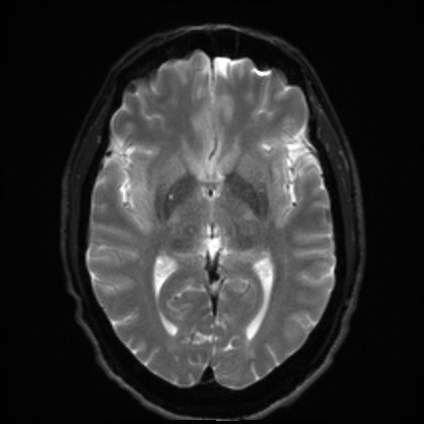 File:Amyotrophic lateral sclerosis (Radiopaedia 87352-103658 Axial DWI 13).jpg
