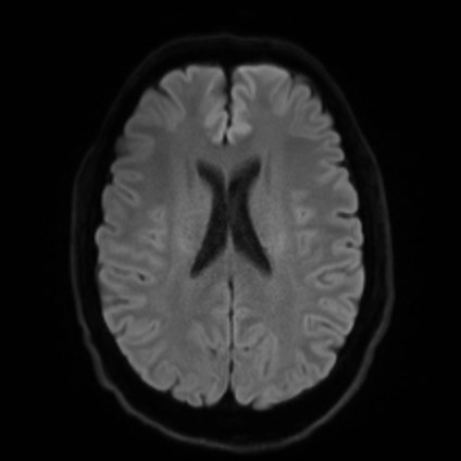 File:Amyotrophic lateral sclerosis (Radiopaedia 87352-103658 Axial DWI 45).jpg