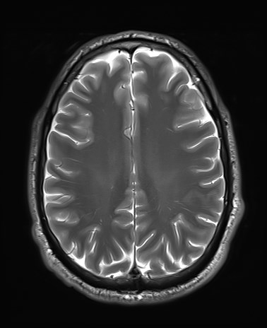 File:Amyotrophic lateral sclerosis (Radiopaedia 87352-103658 Axial T2 20).jpg