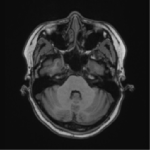 Anaplastic astroblastoma (Radiopaedia 55666-62194 Axial T1 19).png