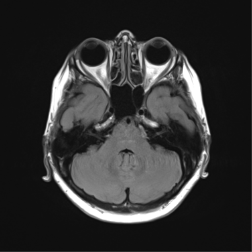 File:Anaplastic astrocytoma (Radiopaedia 86943-103160 Axial FLAIR 8).png