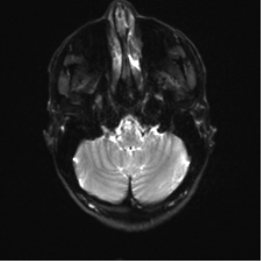 File:Anaplastic astrocytoma IDH mutant (Radiopaedia 50046-55341 Axial DWI 5).png