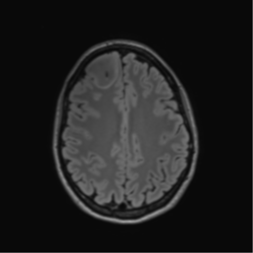 File:Anaplastic astrocytoma IDH mutant (Radiopaedia 50046-55341 Axial FLAIR 35).png