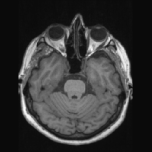 Anaplastic astrocytoma IDH wild-type (pseudoprogression) (Radiopaedia 42209-45276 Axial T1 54).png