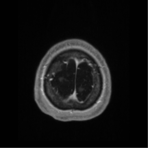 File:Anaplastic astrocytoma IDH wild-type (pseudoprogression) (Radiopaedia 42209-45276 Axial T1 C+ 137).png