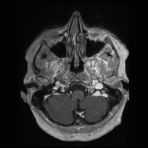 File:Anaplastic astrocytoma IDH wild-type (pseudoprogression) (Radiopaedia 42209-45277 Axial T1 C+ 14).png