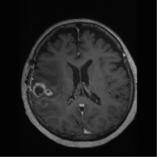 File:Anaplastic astrocytoma IDH wild-type (pseudoprogression) (Radiopaedia 42209-45277 Axial T1 C+ 74).png