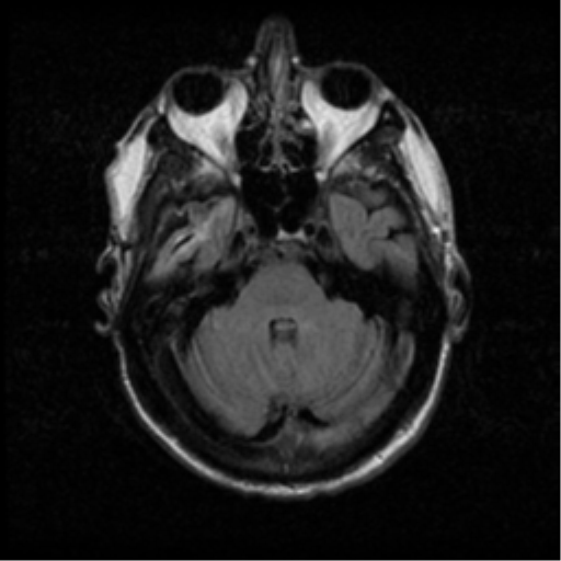 File:Anaplastic meningioma with recurrence (Radiopaedia 34452-35789 Axial FLAIR 7).png