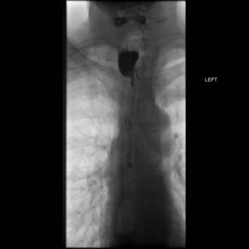 File:Anastomotic stricture post Ivor Lewis esophagectomy (Radiopaedia 47937-52715 B 4).png
