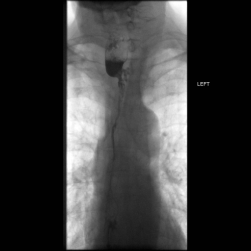 File:Anastomotic stricture post Ivor Lewis esophagectomy (Radiopaedia 47937-52715 Frontal 40).png
