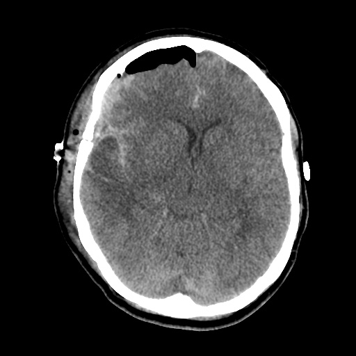File:Aneursym related subarachnoid hemorrhage with hydrocephalus (Radiopaedia 45105-49085 Axial non-contrast 22).jpg
