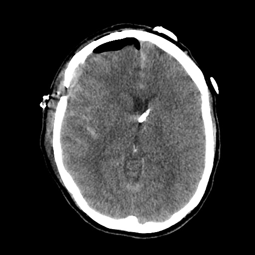 Aneursym related subarachnoid hemorrhage with hydrocephalus (Radiopaedia 45105-49085 Axial non-contrast 25).jpg