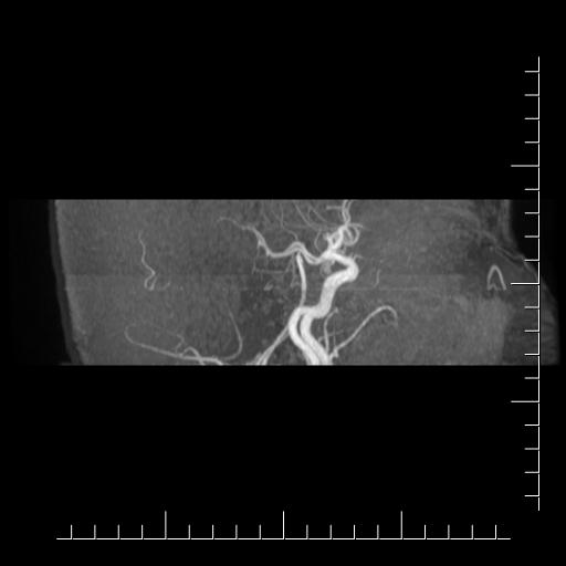 File:Aneurysm of posterior communicating artery (Radiopaedia 20188-20163 MRA 20).jpg