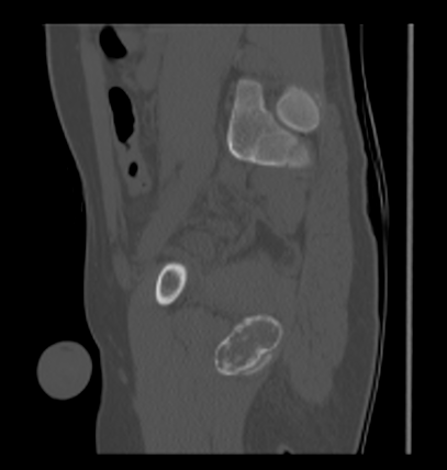 Aneurysmal bone cyst of ischium (Radiopaedia 25957-26094 Sagittal bone window 48).png