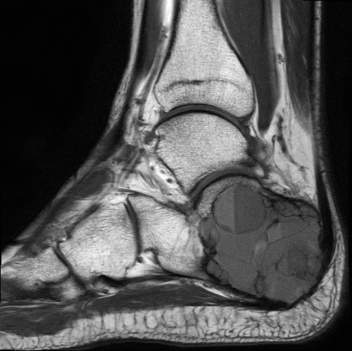 File:Aneurysmal bone cyst of the calcaneus (Radiopaedia 60669-68420 Sagittal T1 9).jpg