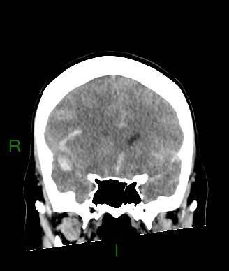 Aneurysmal subarachnoid hemorrhage with intra-axial extension (Radiopaedia 84371-99699 Coronal non-contrast 45).jpg