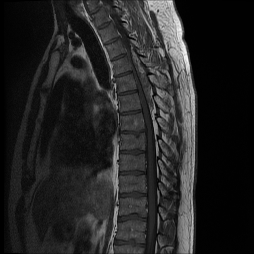 File:Angiolipoma - thoracic spine (Radiopaedia 28242-28479 Sagittal T1 8).jpg