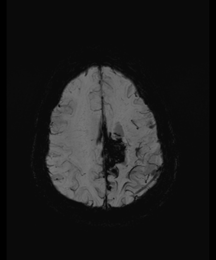 Angiomatous meningioma (Radiopaedia 79459-92579 E 50).jpg