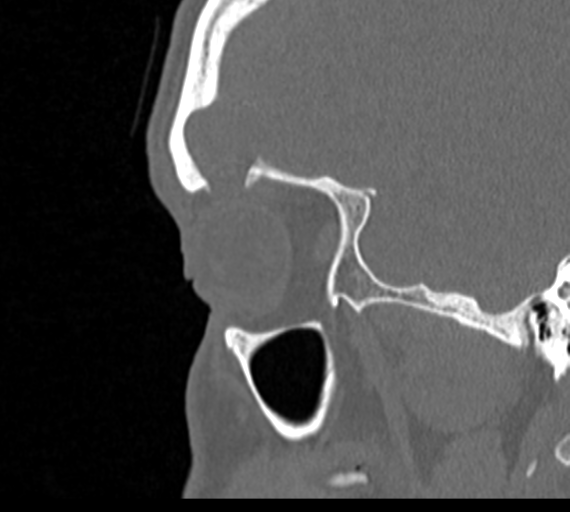 Angular epidermoid cyst (Radiopaedia 46908-51439 Sagittal bone window 77).png