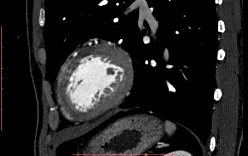 File:Anomalous left coronary artery from the pulmonary artery (ALCAPA) (Radiopaedia 70148-80181 C 206).jpg