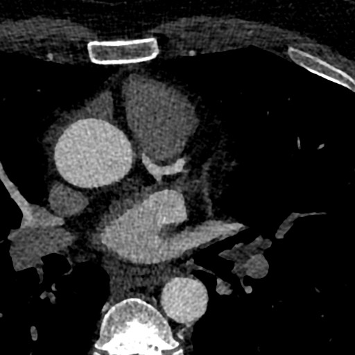 File:Anomalous origin of the left coronary artery with malignant course (Radiopaedia 77842-90126 C 17).jpeg