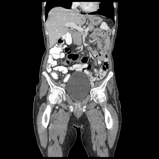 Anorectal carcinoma (Radiopaedia 44413-48064 B 29).jpg