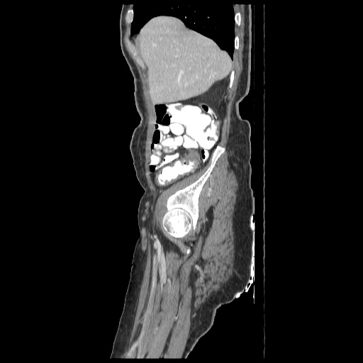 File:Anorectal carcinoma (Radiopaedia 44413-48064 C 14).jpg