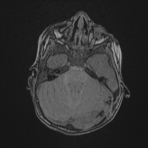 Anoxic brain injury (Radiopaedia 79165-92139 Axial MRA 62).jpg