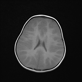 File:Anoxic brain injury (Radiopaedia 79165-92139 Axial T1 18).jpg