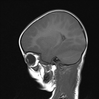 File:Anoxic brain injury (Radiopaedia 79165-92139 Sagittal T1 14).jpg